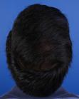 After Hair Transplant&nbsp;Front